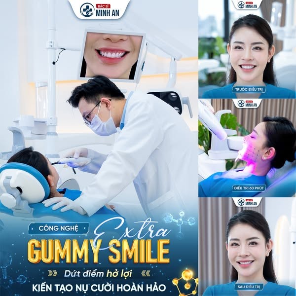Khám Phá Công Nghệ Điều Trị Cười Hở Lợi Tại Dr. Minh An: Nụ Cười Hoàn Hảo Không Cần Phẫu Thuật